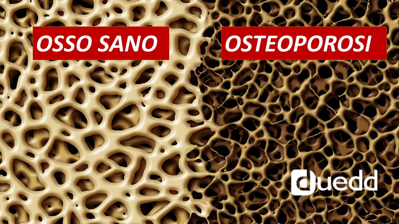 Perche' le donne sono piu' a rischio di osteoporosi?